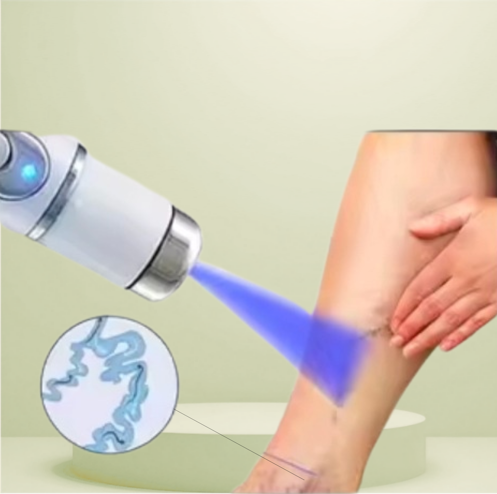 Stylo lumineux pour atténuer l’apparence des varices